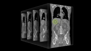 Иллюстрация к релизу открытой модели NVIDIA NV-Reason-CT для анализа трёхмерных КТ-исследований.